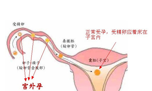 宫外孕患侧输卵管还是切了好